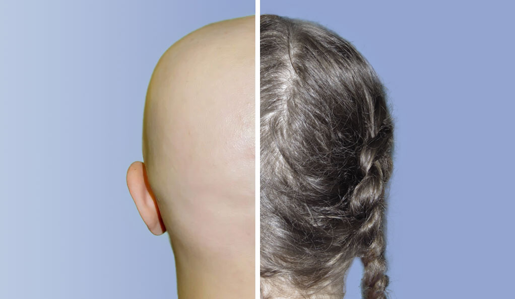 alopecia before and after treatment